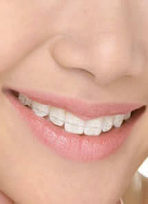 brackets ceramicos.jpg