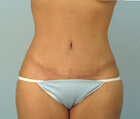 cicatrizabdominoplastia-300x254.jpg